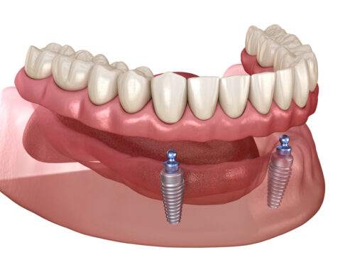 Understanding All-on-X: A Guide to Full Mouth Rehabilitation