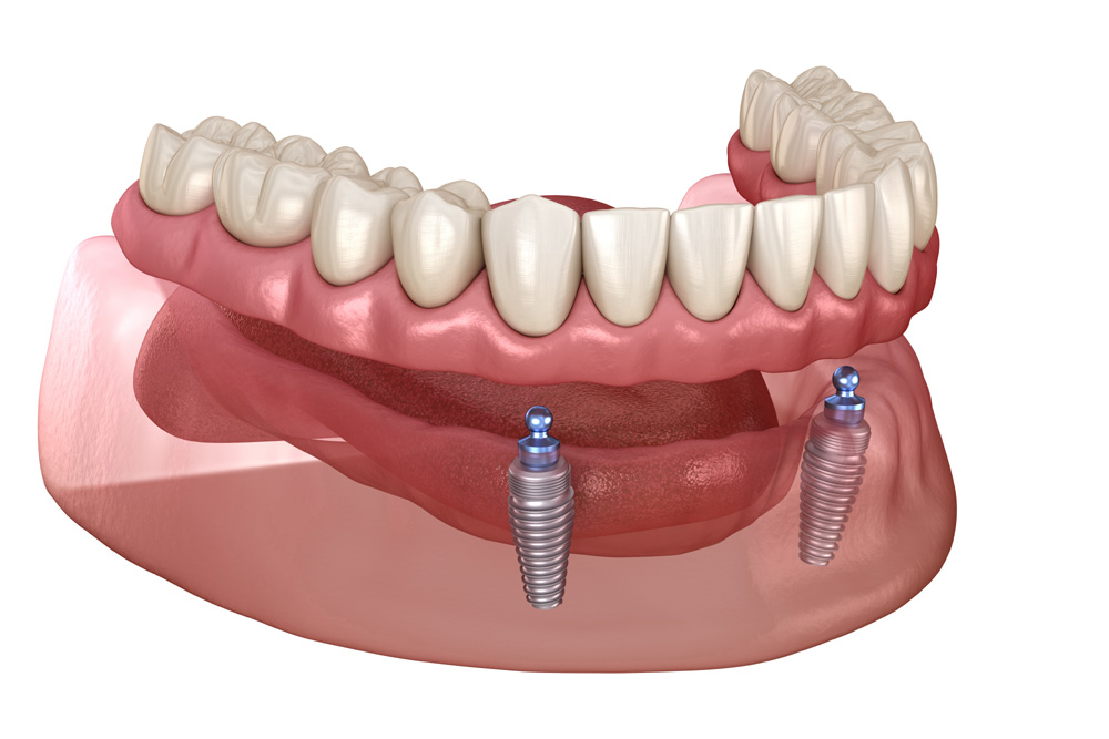 All on 2 system supported by implants